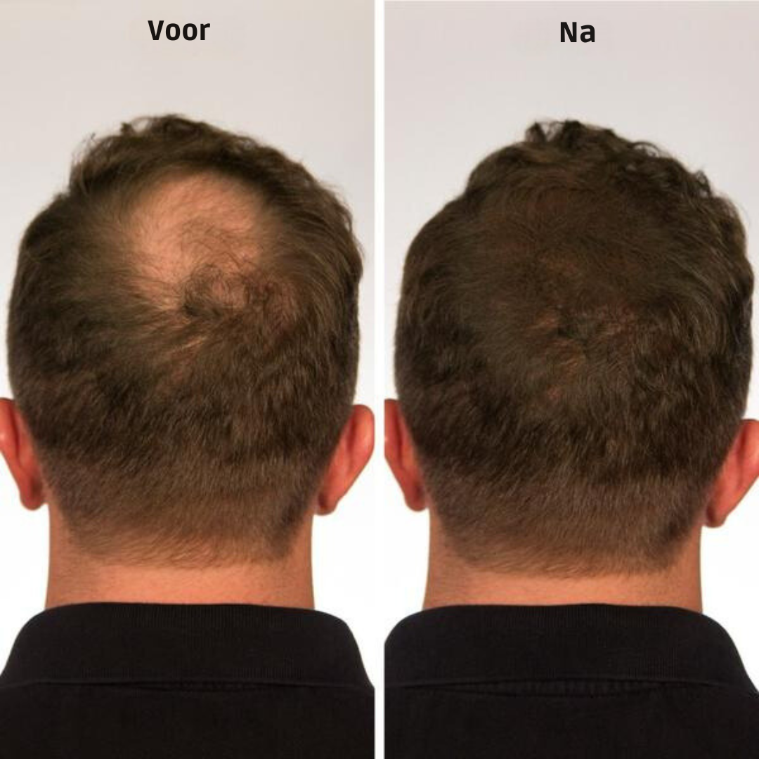 HairLuxe™ | Geen kale plekken meer!