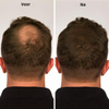 HairLuxe™ | Geen kale plekken meer!