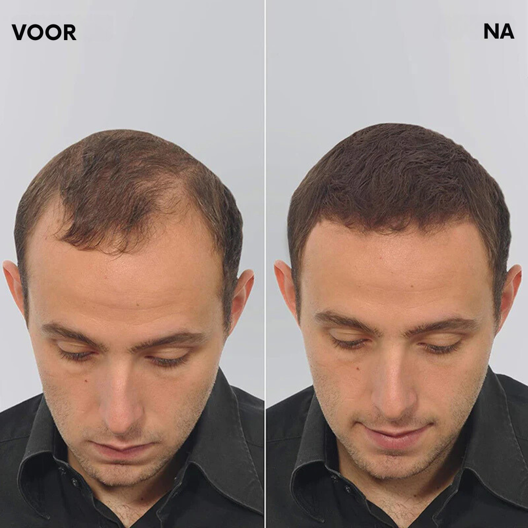 HairLuxe™ | Geen kale plekken meer!