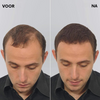 HairLuxe™ | Geen kale plekken meer!