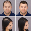 HairLuxe™ | Geen kale plekken meer!