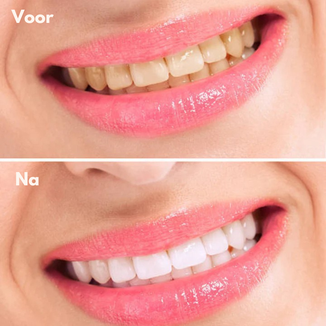 BrightSmile™ | Laat je tanden direct witter stralen